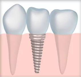 What Are Dental Implants? Call Our Office Near Moore OK For All The Answers