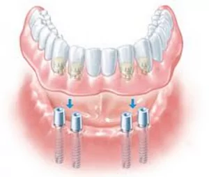 Dentures With Implants From Dentist Near Norman OK